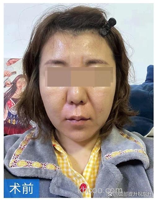 炸窝后窝子能恢复吗？