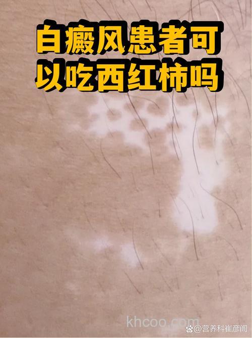 听说有白癜风的人不能吃西红柿?为什么呢?那鱼能吃吗?